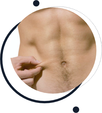 Abdominoplastia Masculina