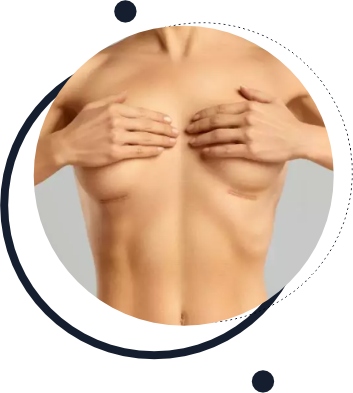 Cicatriz Após Prótese de Silicone Cicatriz Após Prótese de Silicone
