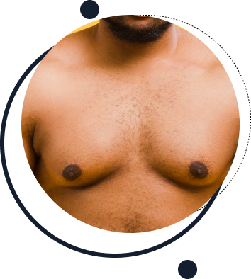 Lipomastia Masculina