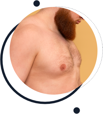 Sinais da Ginecomastia Sinais da Ginecomastia